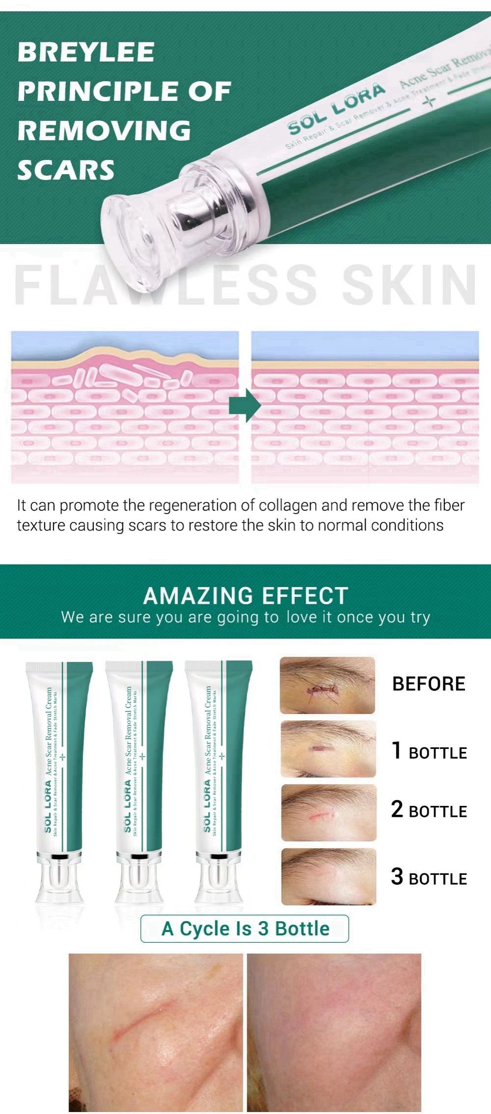 Scar Cream, Face Pimples Scar Stretch Marks Cream Moisturizing Repair Damaged Skin Gel Scar Treatment