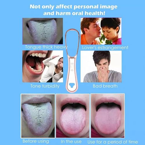 Tongue Scraper for Adults,Reduce Bad Breath,Metal Tongue Scraper,Tongue Cleaner,Tongue Scraper,Stainless Steel Tongue Scraper Tongue Cleaner,Tongue Scrubber Oral Hygiene 3in1 with rose gold metal case