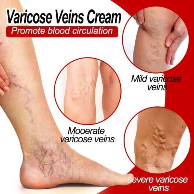 ERAYCEE Varicose Vein Cream - Spider Vein Treatment, Leg Circulation & Pain Relief, Skin Firming