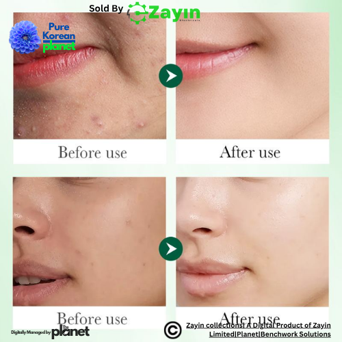 Korean Acne Serum with Salicylic Acid
Anti-Aging Serum for Acne-Prone Skin
Pore Tightening Face Serum
Blemish Repair Serum for Oily Skin
Soothing Acne Treatment Essence