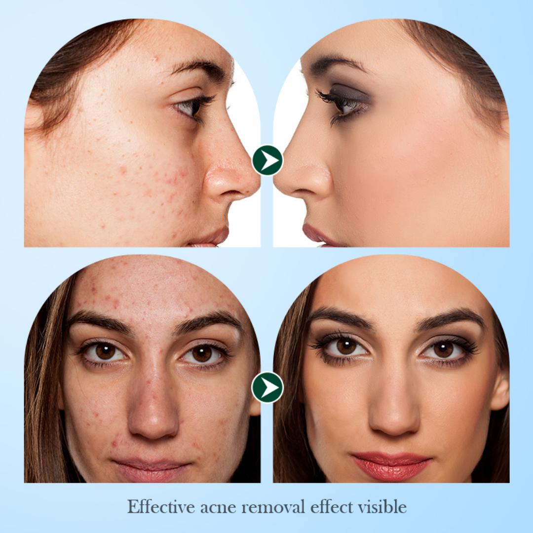10 SADOER Tea Tree Acne Removing Facial Mask is a sheet mask designed to address acne and oily skin concerns.Formulated with tea tree essential oil,Natural antibacterial and anti-inflammatory.