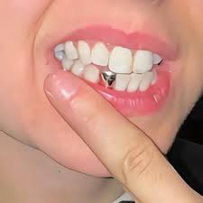 Silver tooth cap grillz