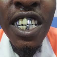 Silver tooth cap grillz