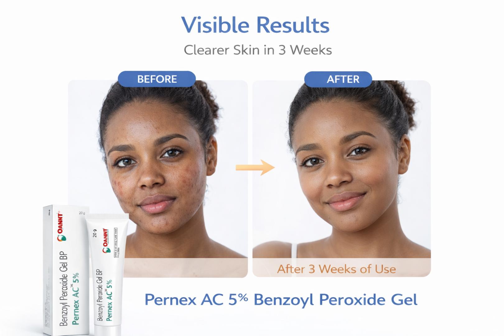 Pernex AC 5% Benzoyl Peroxide Gel 20g – Acne Treatment, Pimple Remover, Spot Treatment for Breakouts & Oily Skin