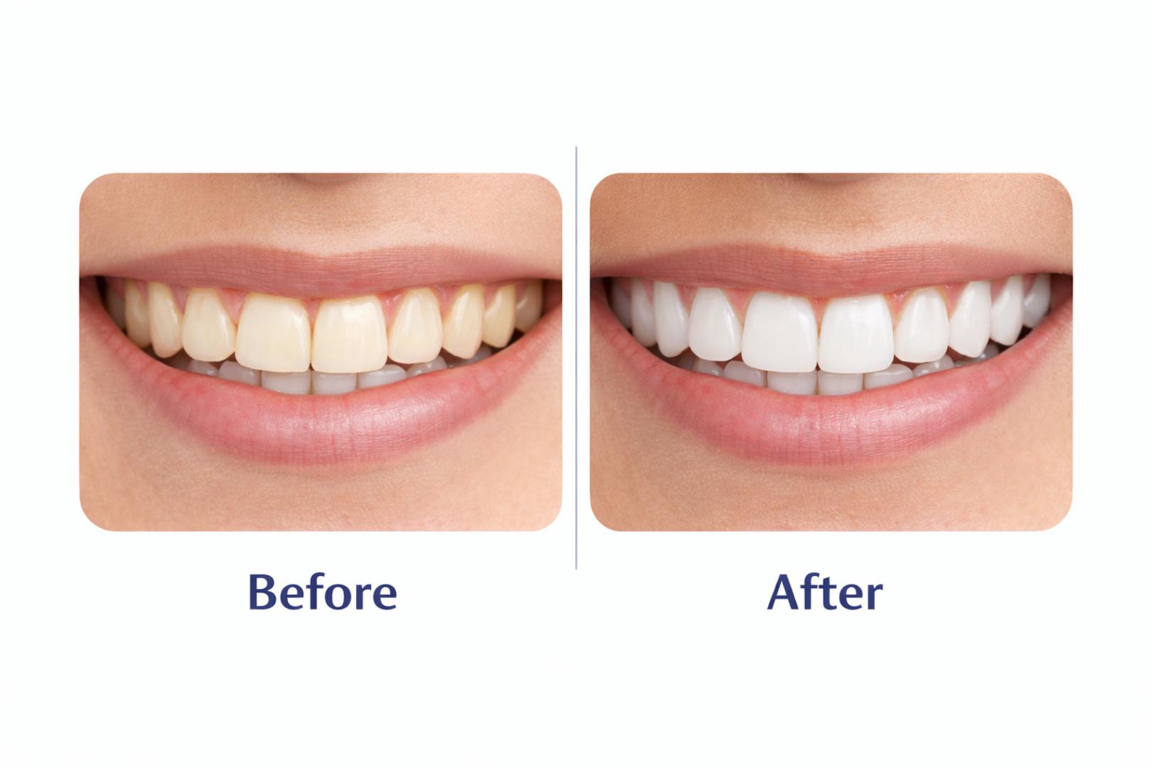 5D White Teeth Whitening Strips Kit – Professional Fast Whitening Dental Strips for Bright Smile (Full Set)