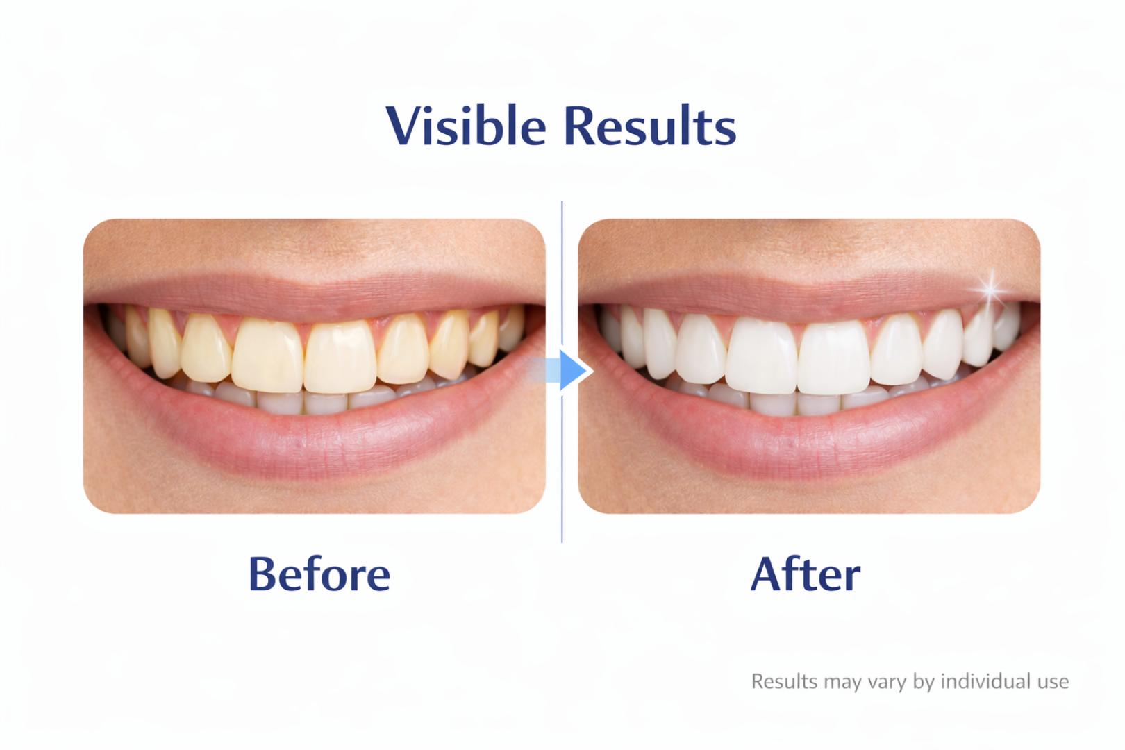 5D White Teeth Whitening Strips Kit – Professional Fast Whitening Dental Strips for Bright Smile (Full Set)