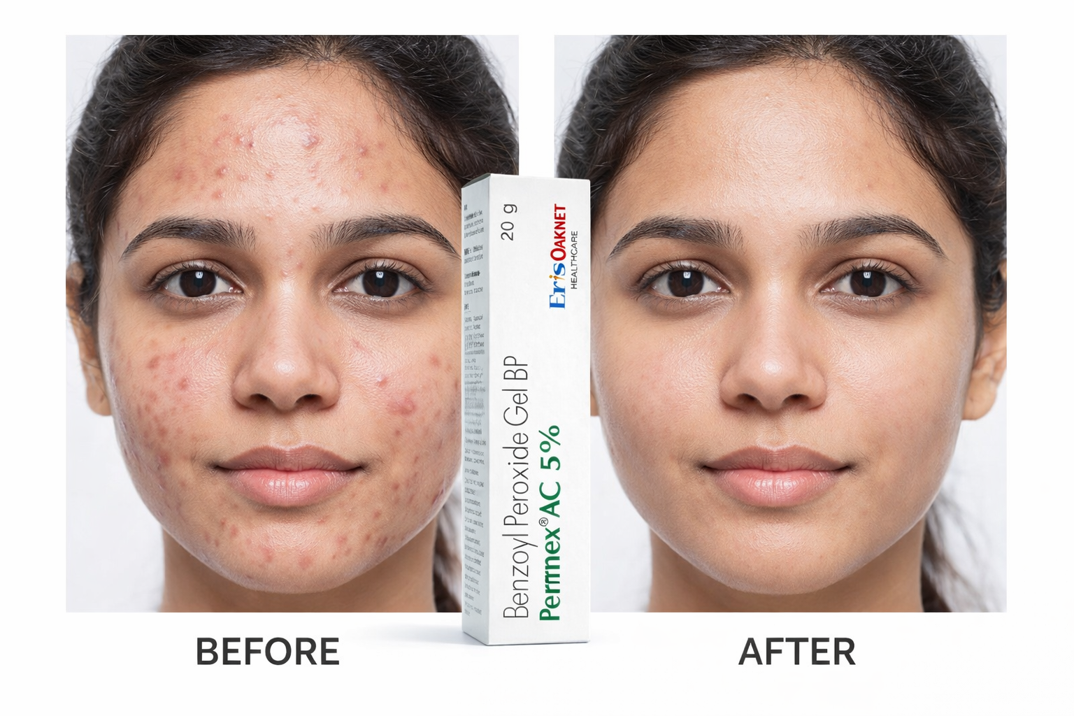 Pernex AC 5% Benzoyl Peroxide Gel BP 20g – Acne Treatment for Pimples & Blemishes | Eris Oaknet Healthcare