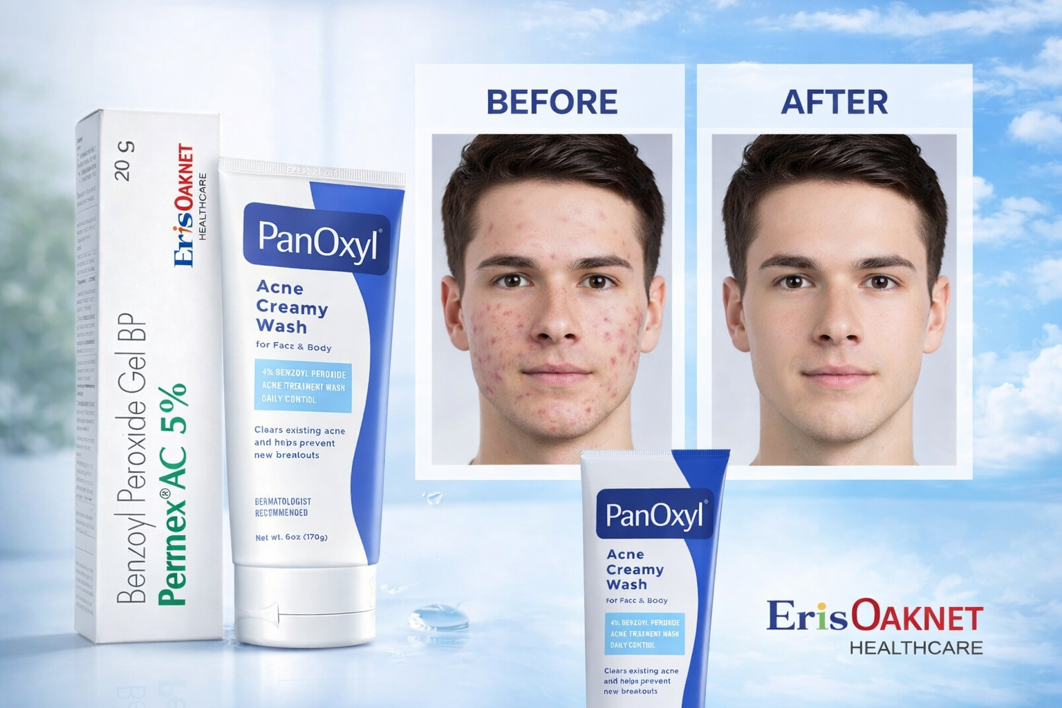Powerful Acne Treatment Duo: Pernex® AC 5% Benzoyl Peroxide Gel & PanOxyl® Acne Creamy Wash for Clear, Healthy Skin (Face & Body)| anti acne skincare set