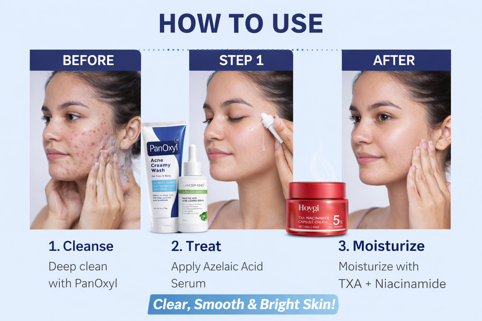 Acne Treatment Skincare Kit | Benzoyl Peroxide Face Wash | Azelaic Acid Salicylic Acid Serum | TXA Niacinamide Brightening Cream | Pimple, Dark Spot & Oil Control Set