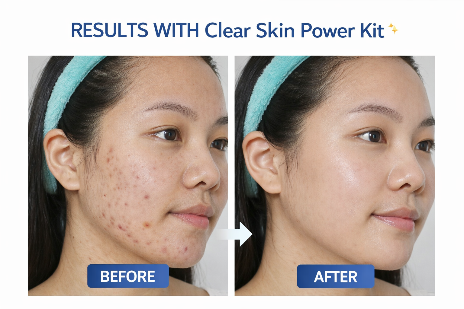 Acne Clear Skin Power Kit ✨ PanOxyl Acne Wash + Azelaic Acid Serum + Hydrating Cream + SPF50 Sunscreen | Complete Daily Routine for Acne-Free, Smooth & Glowing Skin