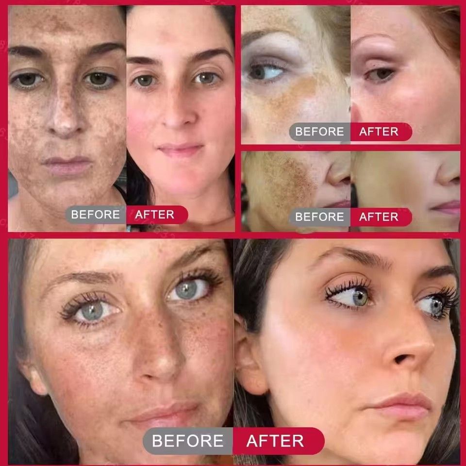 BARUBT Powerful bleaching cream removing stains, lightens the skin, quickly removes melanin pigmentation, melasma, dark spots B2-1028