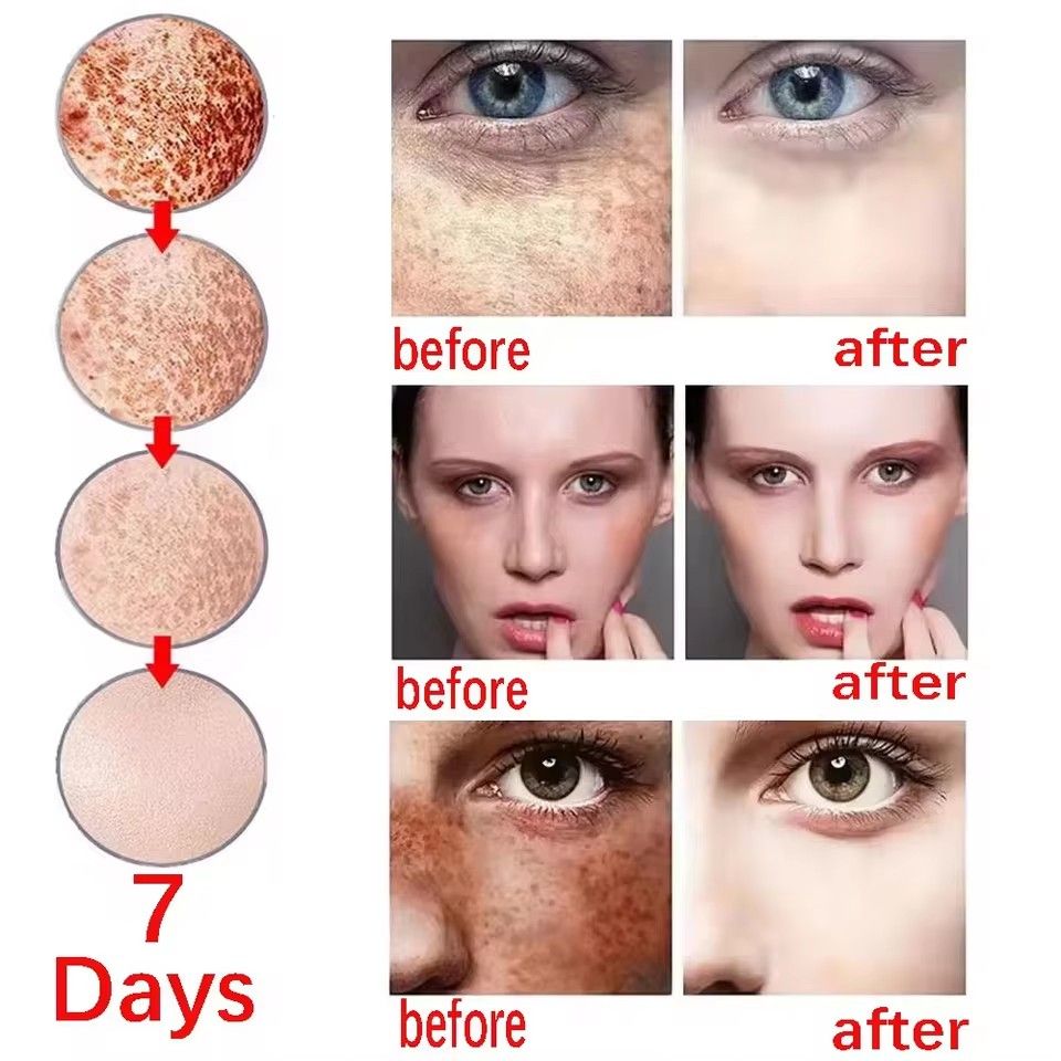 BARUBT Powerful bleaching cream removing stains, lightens the skin, quickly removes melanin pigmentation, melasma, dark spots B2-1028
