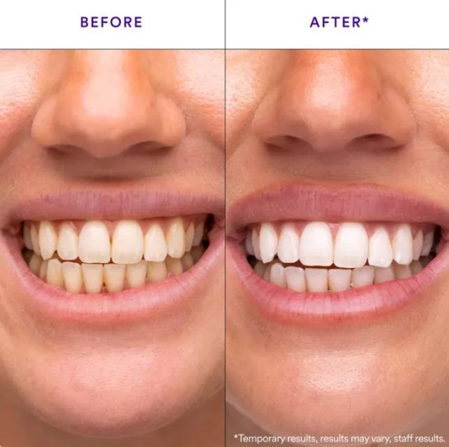 Hismile V34 Teeth Whitening Strips Purple Tooth Whitening Tooth Stain Treatment Combining Whitening and Colour Correction