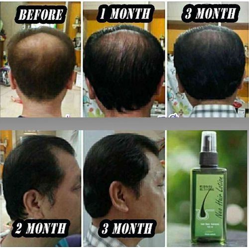 Neo Hair  Lotion-Hair Treatment Hair Root Nutrients -120mL