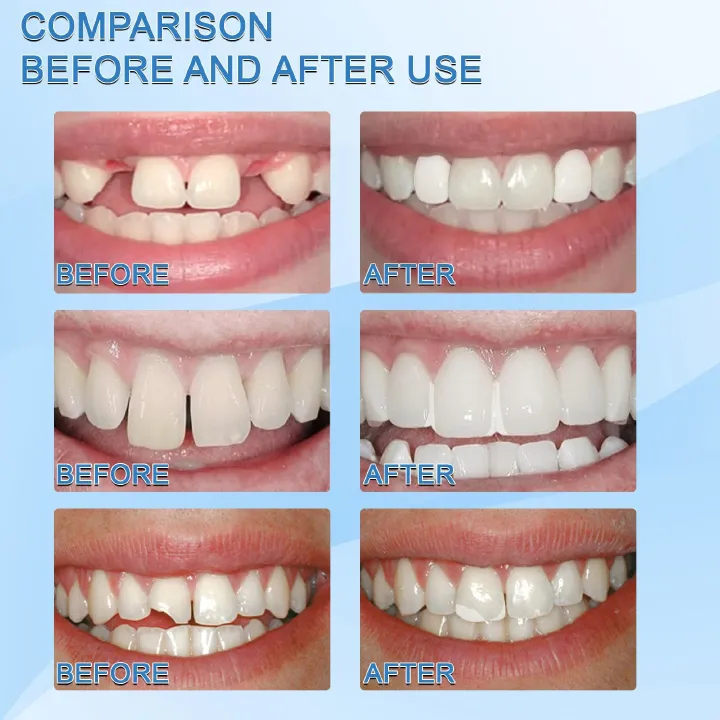 30ml Resin Temporary Tooth Repair Granules Teeth Gaps Missing Broken Tooth False Teeth Filling Moldable Solid Glue Dental Care