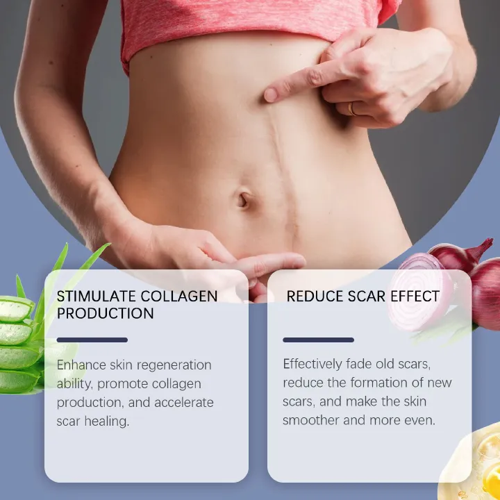 Medical-Grade Silicone Scar Gel for Surgery, C-Section & Keloids | Advanced Scar Cream with Onion Extract | Visibly Minimizes Old & New Scars, Stretch Marks & Bumps