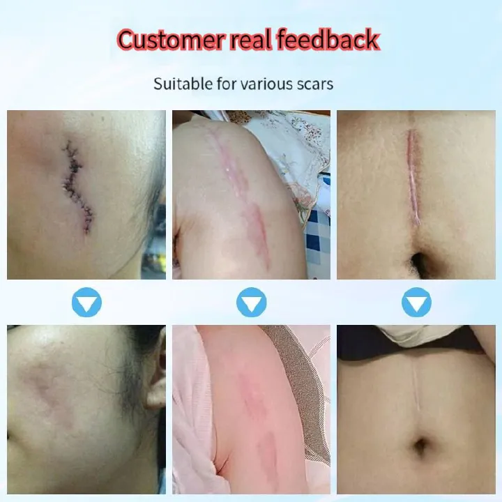 Medical Silicone Scar Gel Scar Cream Burn Burn C-section Scar Removal Cream