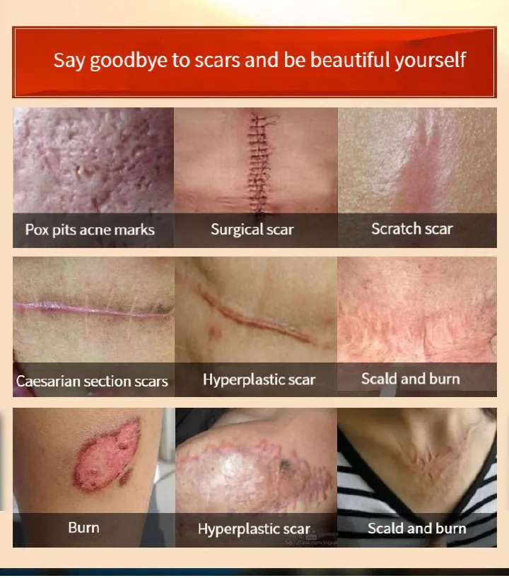 Medical Silicone Scar Gel Scar Cream Burn Burn C-section Scar Removal Cream