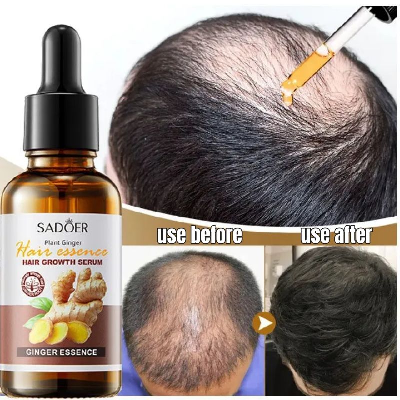 SADOER Nature Ginger Essence Hair Growth Oil Hair Growth Serum Hair Strengthening Treatment Scalp Treatment Promotes Hair Growth Thins Hair Solution Reduces Hair Breakage Strengthens Hair Roots