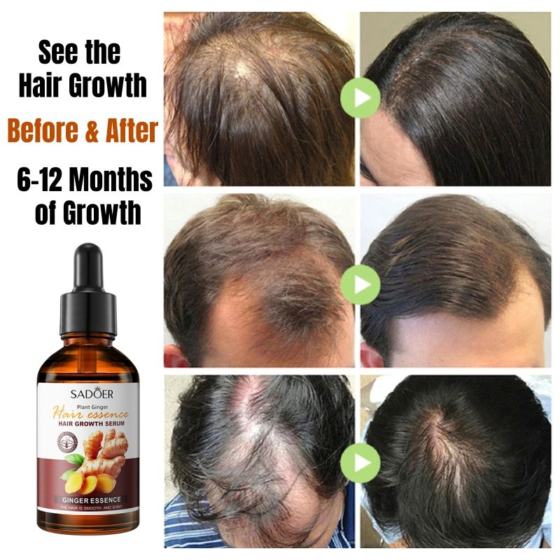 SADOER Nature Ginger Essence Hair Growth Oil Hair Growth Serum Hair Strengthening Treatment Scalp Treatment Promotes Hair Growth Thins Hair Solution Reduces Hair Breakage Strengthens Hair Roots