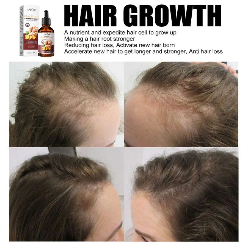 SADOER Nature Ginger Essence Hair Growth Oil Hair Growth Serum Hair Strengthening Treatment Scalp Treatment Promotes Hair Growth Thins Hair Solution Reduces Hair Breakage Strengthens Hair Roots