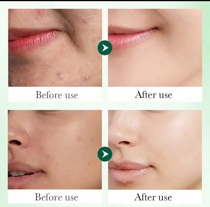 ACNE SKIN CARE TREATMENT _SADOER TONER +SADOER SERUM+ALOE VERA GEL+ASANTEE GOAT AND TAMARIND SOAP. THIS SKIN CARE SET WILL DRY UP ACNE AND PIMPLES , UNCLOG PORES, AND CONTROL OIL ON ACNE PRONE SKIN