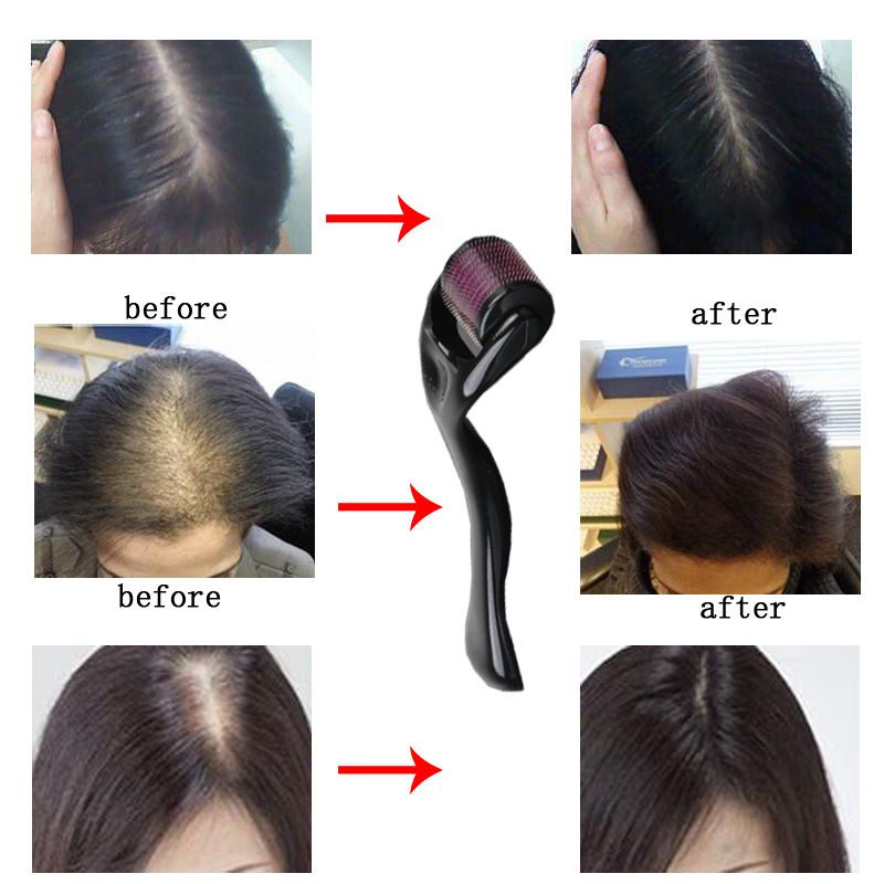 Micro Needles Micro-needling Roller for Hair Regrowth Beard Growth Thinning Hair Receding Hairline Bald Spots Black 0.25mm