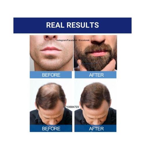 Kirkland Minoxidil 5% extra strength hair loss regrowth system treatment for men Beard care oil premium Topical Solution bottle of 60ml