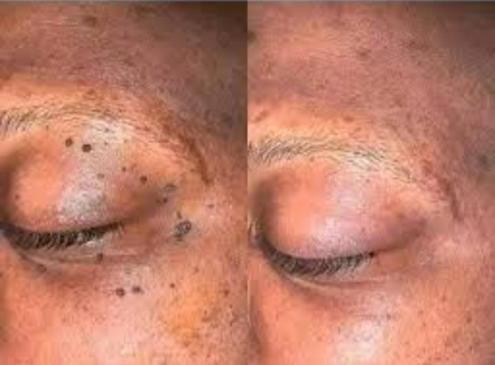 Magic Wart Removal Cream