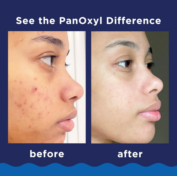 PanOxyl Acne Creamy Wash 4% Benzoyl Peroxide Face & Body Cleanser – Clears Acne & Prevents