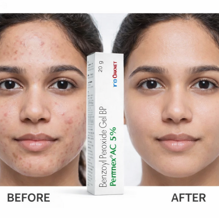 Best price for Acne Cream – 5% Benzoyl Peroxide Acne Treatment Gel for ...