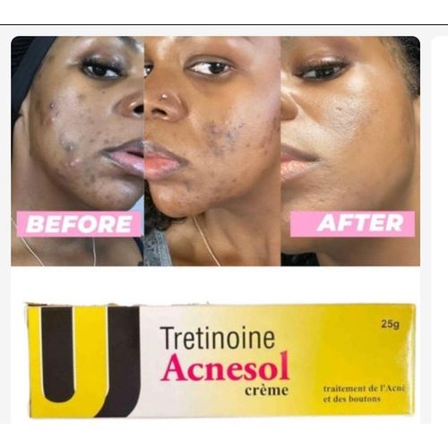 ACNESOL (TRETINOIN) CREAM 25G.