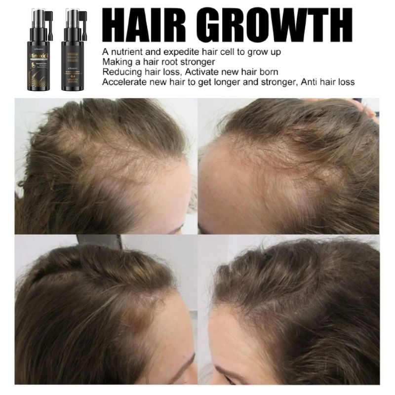 KORMESIC 5% Minoxidil & Biotin Hair Growth Serum Hair Regrowth Strengthen Hair Dual Action Anti Hair Loss Treatment Activates Hair Follicles for Thicker Stronger Hair Penetrating Fast Absorbing