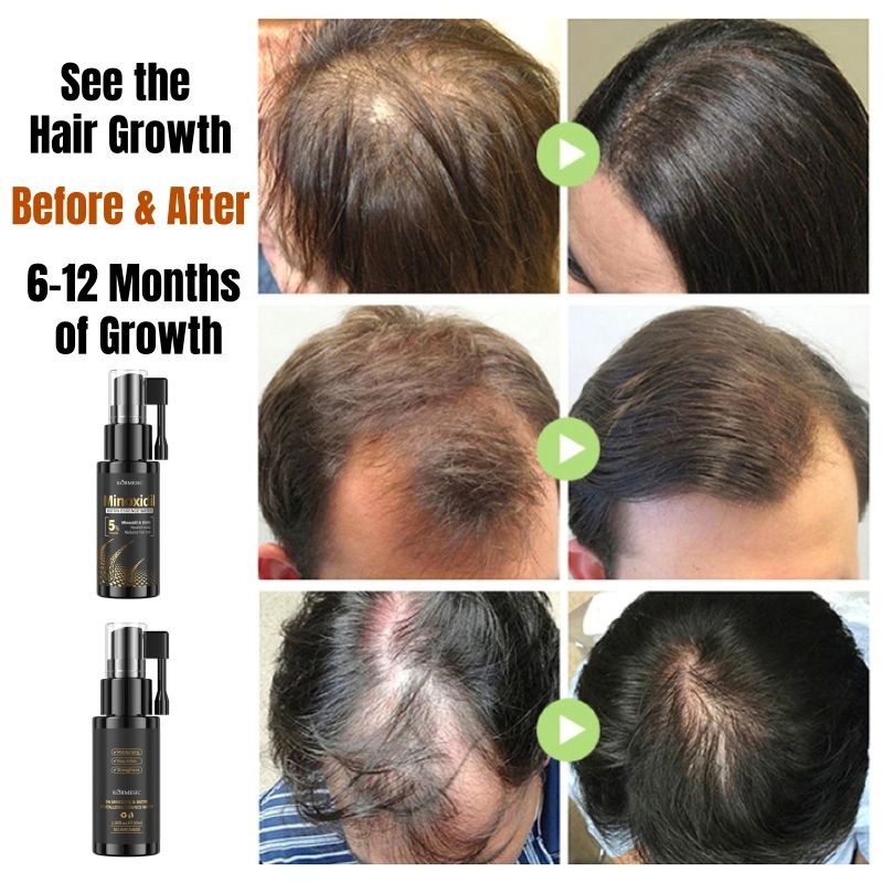 KORMESIC 5% Minoxidil & Biotin Hair Growth Serum Hair Regrowth Strengthen Hair Dual Action Anti Hair Loss Treatment Activates Hair Follicles for Thicker Stronger Hair Penetrating Fast Absorbing