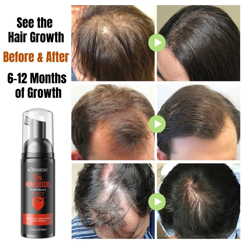 KORMESIC 5% Minoxidil Hair Beard Growth Foam Hair Regrowth Treatment Anti Hair Loss Activates Follicles Thicker Hair Fills Thin Spot Faster Hair Growth Strengthen Hair Stronger Hair Penetrating