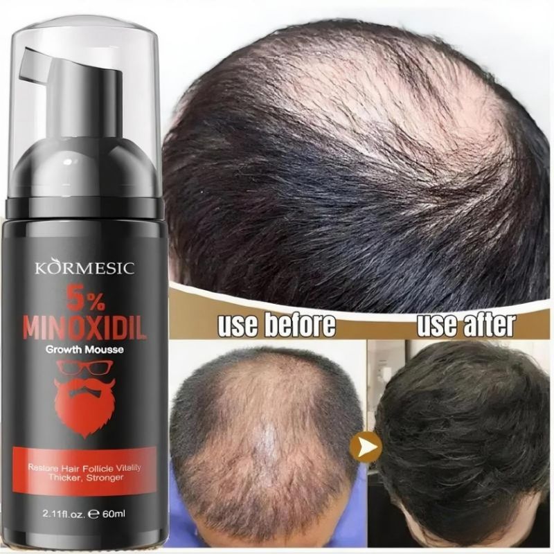 KORMESIC 5% Minoxidil Hair Beard Growth Foam Hair Regrowth Treatment Anti Hair Loss Activates Follicles Thicker Hair Fills Thin Spot Faster Hair Growth Strengthen Hair Stronger Hair Penetrating