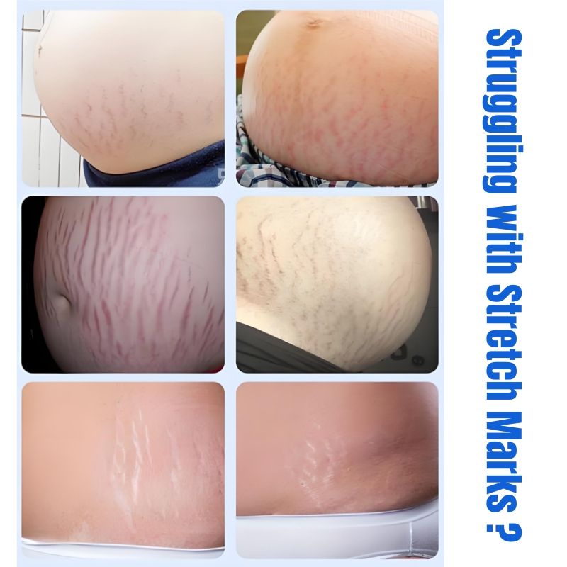 KORMESIC 100% Natural Herbal Stretch Mark Cream Reduces Stretch Marks Safe Mom Pregnancy Belly Cream Anti-Wrinkle Moisturizing Whitening Firms Skin Cell Regeneration Reduce Wrinkles Firm Wrinkled Skin