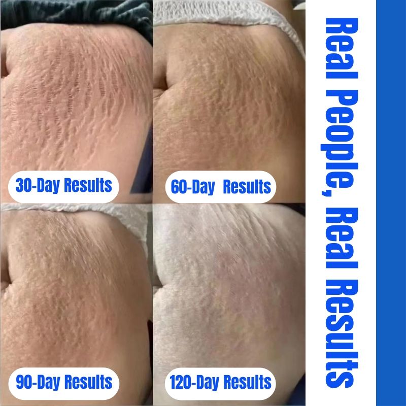 KORMESIC 100% Natural Herbal Stretch Mark Cream Reduces Stretch Marks Safe Mom Pregnancy Belly Cream Anti-Wrinkle Moisturizing Whitening Firms Skin Cell Regeneration Reduce Wrinkles Firm Wrinkled Skin