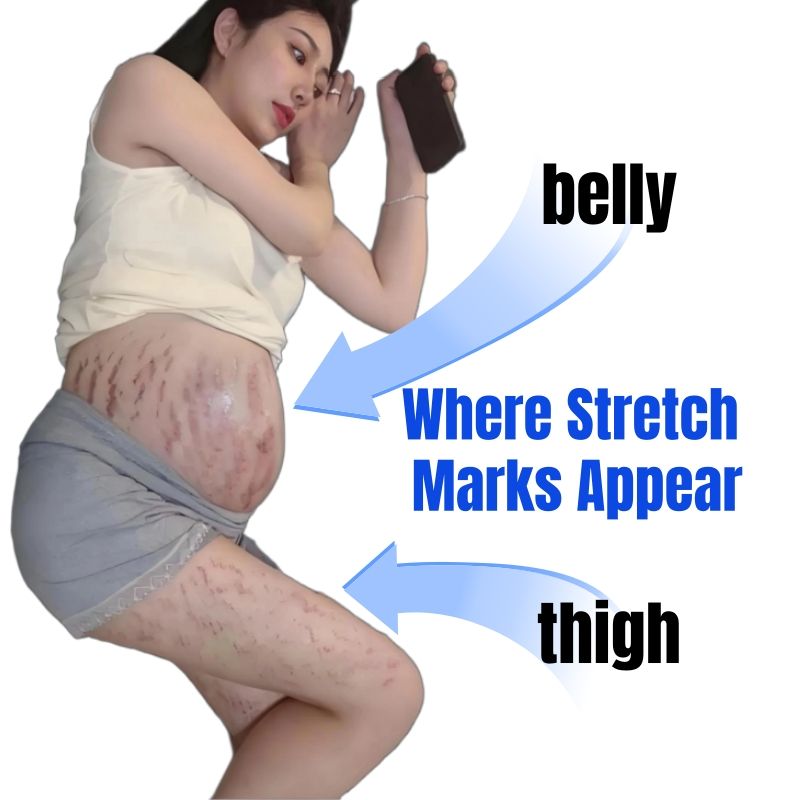 KORMESIC 100% Natural Herbal Stretch Mark Cream Reduces Stretch Marks Safe Mom Pregnancy Belly Cream Anti-Wrinkle Moisturizing Whitening Firms Skin Cell Regeneration Reduce Wrinkles Firm Wrinkled Skin