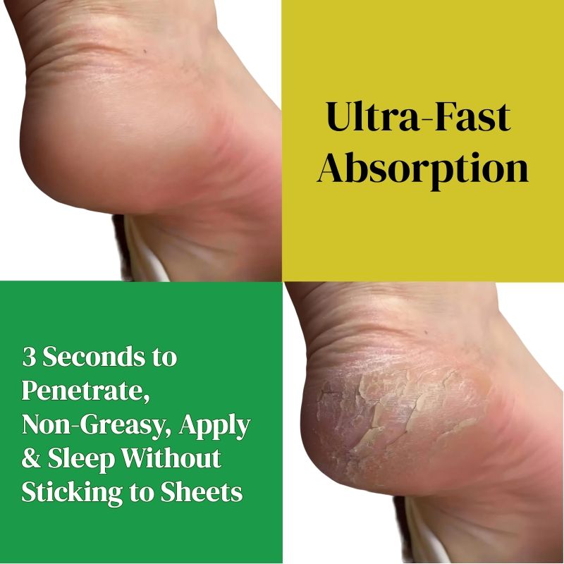 KORMESIC Feet Chapped Cream Repair Cracked Heels Dry Cracked Feet Rescue Foot Cracks Split Heels Hard Skin & Cracks Heel Fissures Plantar Rhagades Painless Deep Skin Fissures Moisturizer 100g