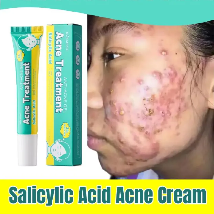 KORMESIC Salicylic Acid Acne Cream Arbutin Acne Treatment Cream Centella Asiatica Anti-Acne Cream Gently Reduces Redness Unclogs Pores Controls Oil Fades Dark Spots Smooth Clear Skin - Acne Prone Skin