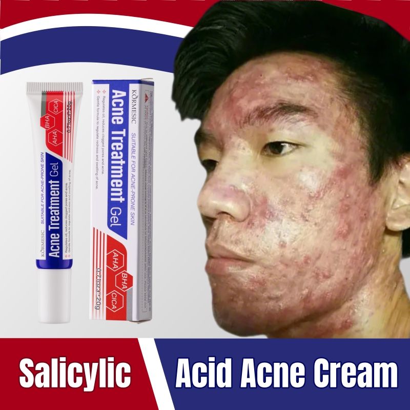KORMESIC Salicylic Acid Acne Cream Arbutin Acne Treatment Cream Centella Asiatica Anti-Acne Cream Gently Reduces Redness Unclogs Pores Controls Oil Fades Dark Spots Smooth Clear Skin - Acne Prone Skin