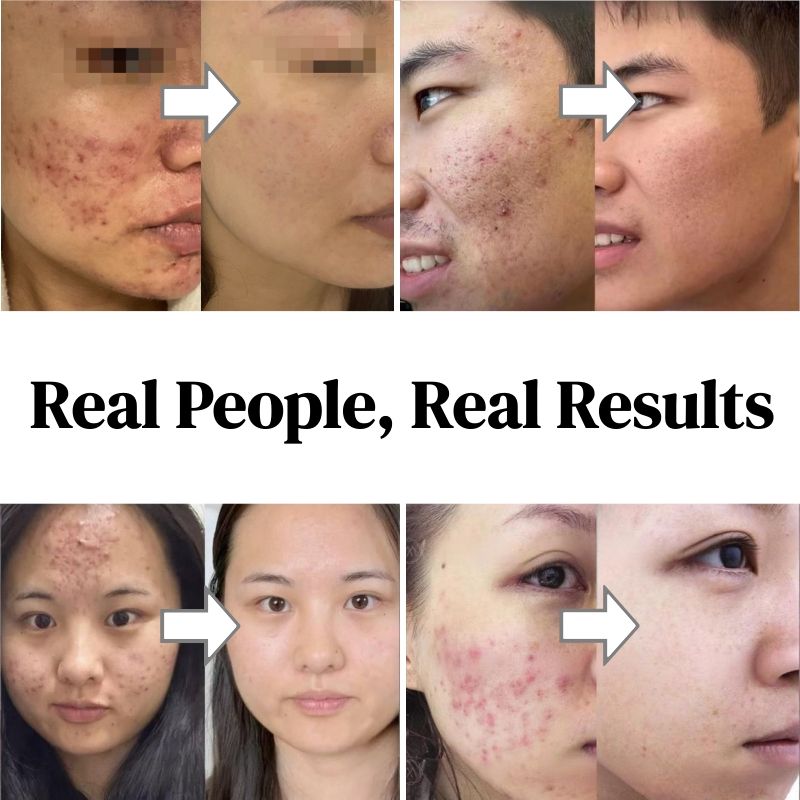 KORMESIC Salicylic Acid Acne Cream Arbutin Acne Treatment Cream Centella Asiatica Anti-Acne Cream Gently Reduces Redness Unclogs Pores Controls Oil Fades Dark Spots Smooth Clear Skin - Acne Prone Skin