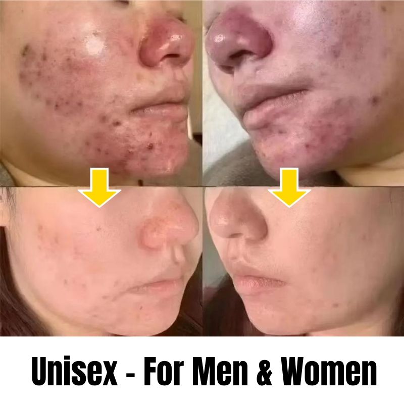 KORMESIC Salicylic Acid Acne Cream Arbutin Acne Treatment Cream Centella Asiatica Anti-Acne Cream Gently Reduces Redness Unclogs Pores Controls Oil Fades Dark Spots Smooth Clear Skin - Acne Prone Skin