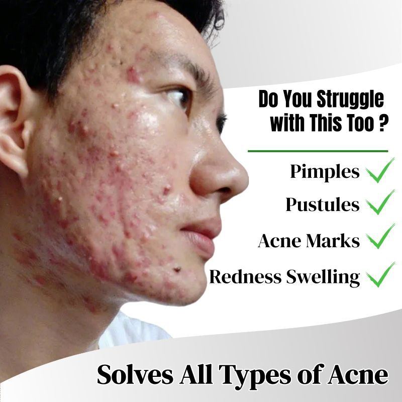 KORMESIC Salicylic Acid Acne Cream Arbutin Acne Treatment Cream Centella Asiatica Anti-Acne Cream Gently Reduces Redness Unclogs Pores Controls Oil Fades Dark Spots Smooth Clear Skin - Acne Prone Skin
