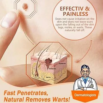 Aichun Beauty Warts Remover Cream/ Anti-Wart Cream/Wart Treatment, Skin Tags & Light Moles Removal -20g