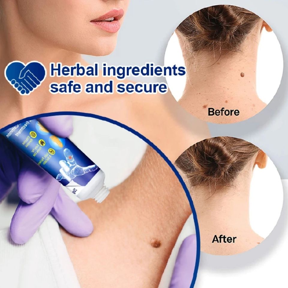 Sumifun Warts Remover Antibacterial Ointment Wart Treatment Cream Skin Tag Remover Herbal Extract Corn Plaster Warts Ointment