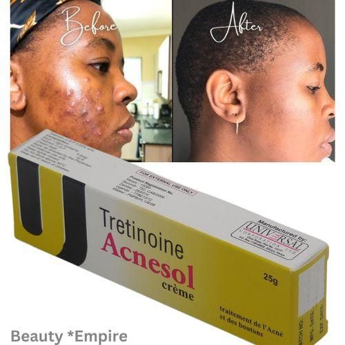 ORIGINAL Acnesol Tretinoin Cream 25g, tretinoin Acnesol Acne Cream 25g - Powerful Acne Treatment For Clearer, Smoother Skin