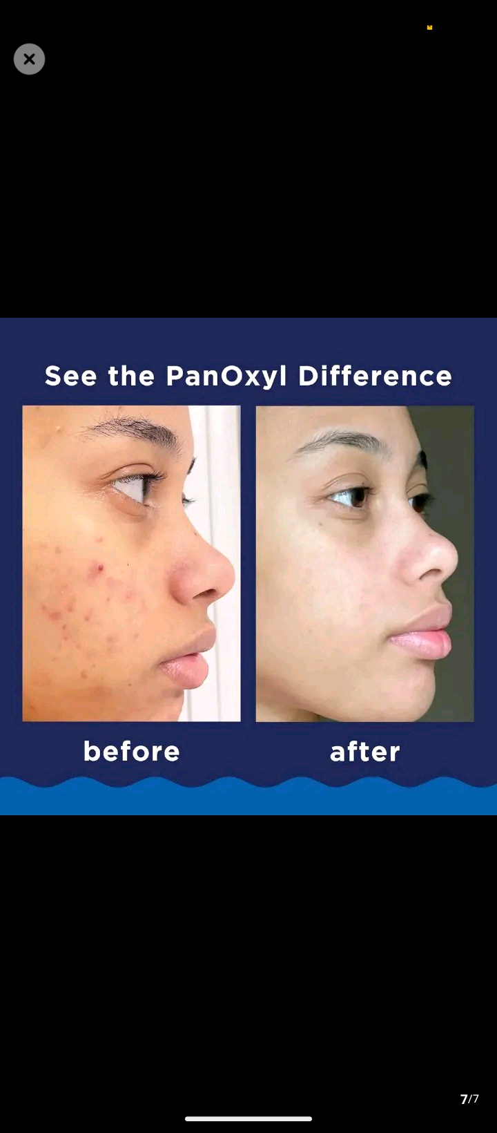 Benzoyl Peroxide Acne Cleanser | Anti-Pimple Facial Wash for Oily & Acne-Prone Skin