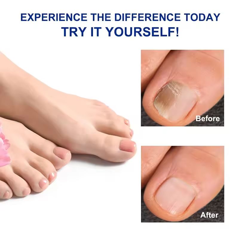 21 Patches Fungal Nail Treatment | Toenail Fungus Repair | Nail Discoloration & Brittle Nails | Overnight Hydrogel Care | Hypoallergenic | Easy to Apply | Ship to Kenya